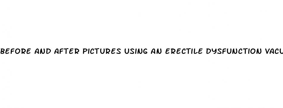 Before And After Pictures Using An Erectile Dysfunction Vacuum Pump - ﻿Pendidikan